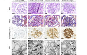 Nature子刊：首次揭示肝炎和腎損傷之間的聯(lián)系