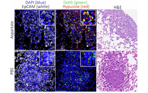 Nature：癌癥轉移時為何青睞肺部？