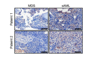 Nature：?；撬崮芡苿?dòng)白血病癌細(xì)胞生長！