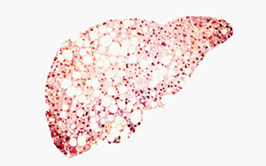 Cell：高脂飲食迫使肝細胞自保，卻最終誘發(fā)肝癌