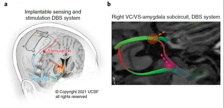 腦電刺激成功拯救重度抑郁癥患者，治愈抑郁癥時代離我們不遠了？