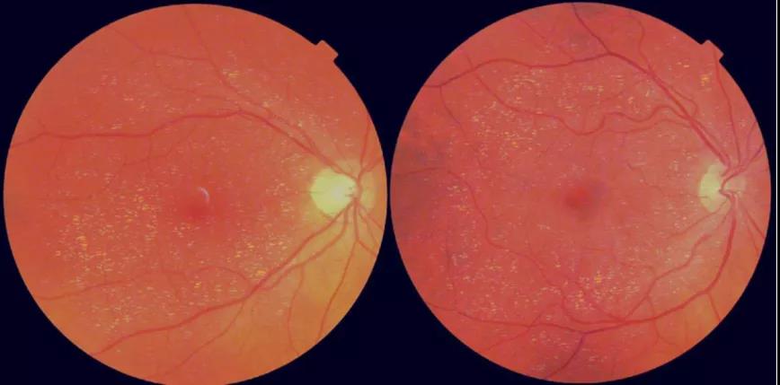 眼睛竟是“年齡之窗”？視網(wǎng)膜年齡差距或可預(yù)測(cè)壽命長(zhǎng)短
