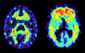 新冠帶來新的“醫(yī)療壓力”：阿爾茨海默病的風(fēng)險飆升50%-80%