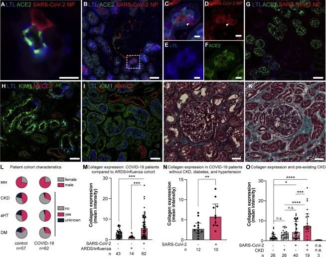 新冠病毒存在于感染者的腎細胞中并誘導腎臟纖維化