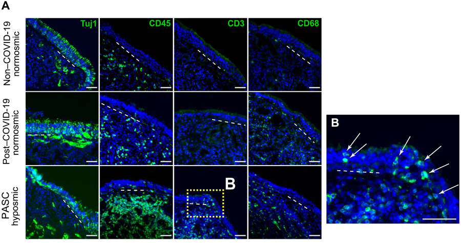 新冠肺炎急性后遺癥嗅覺(jué)粘膜下丘組織學(xué)評(píng)估提示T細(xì)胞浸潤(rùn)的作用 新冠肺炎急性后遺癥嗅覺(jué)粘膜下丘組織學(xué)評(píng)估提示T細(xì)胞浸潤(rùn)的作用