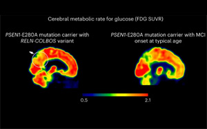 Nature Medicine發(fā)現(xiàn)了新的基因變異，可以預(yù)防阿爾茨海默病
