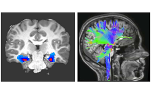 Nature Medicine：一種新的強迫癥神經(jīng)生物標(biāo)志物