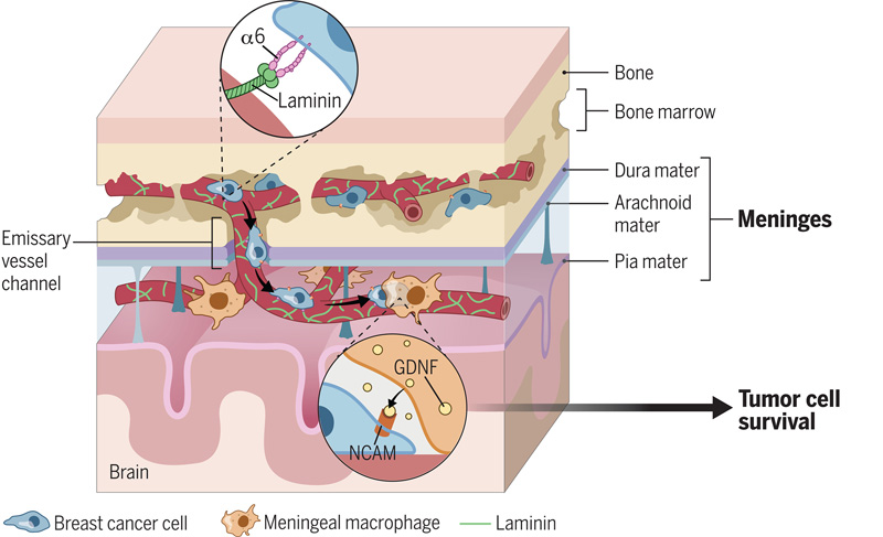 乳腺癌細胞轉(zhuǎn)移和在腦脊膜的促生交互 乳腺癌細胞轉(zhuǎn)移和在腦脊膜的促生交互
